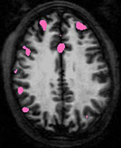 IRM d'un cerveau buveur