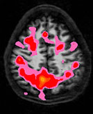 IRM d'un cerveau non buveur